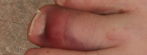 Middle toe a little purple